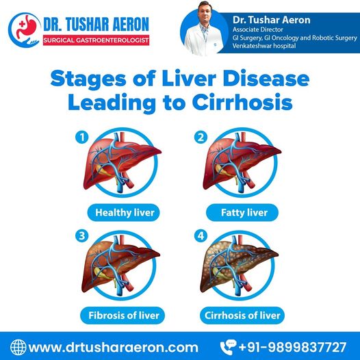 Liver Disease Treatment